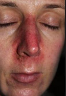 Redness around Nose