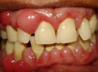 Swollen Gums causes