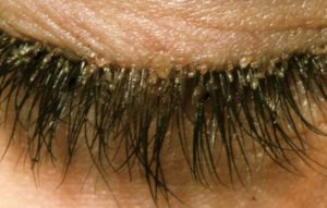 eyelash mites demodex