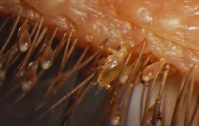 Eyelash Mites Pictures