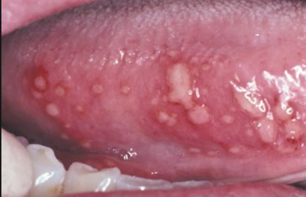 Swollen Taste Buds, Inflamed, Causes on Sides, Tip, Under and on Back