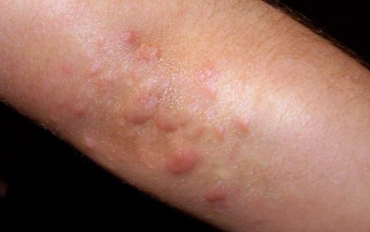 what is the best treatment for psoriasis