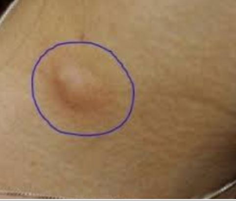 Lump In Armpit Female Picture