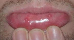 cyst mouth mucous mucocele oral bumps rid retention causes remedies