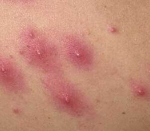 Bumps on Buttocks – Treat MD