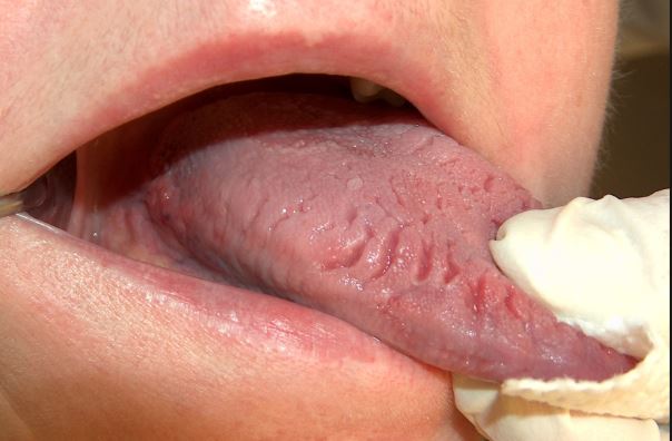 Scalloped Tongue Meaning - Pictures