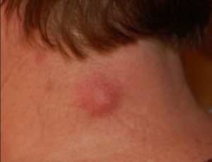 Lump on Back of Neck, Hairline, under Skin, Right Side, Left, Near