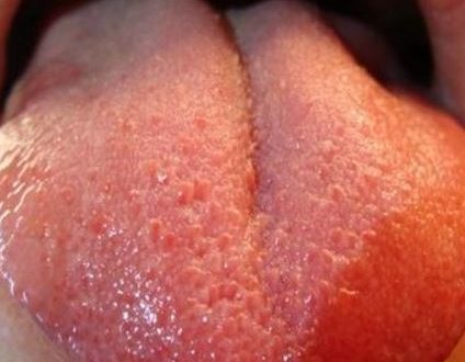 Swollen Taste Buds, Inflamed, Causes on Sides, Tip, Under ...
