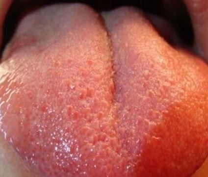 Swollen Taste Buds Image