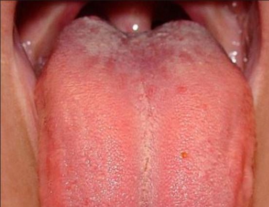 Swollen Taste Buds on back of Tongue.