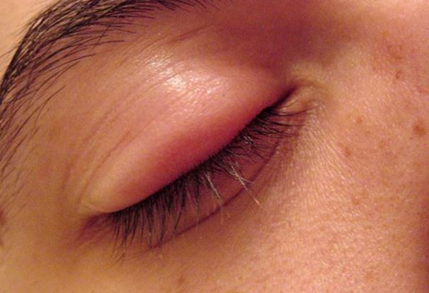 Swollen upper Eyelid Picture