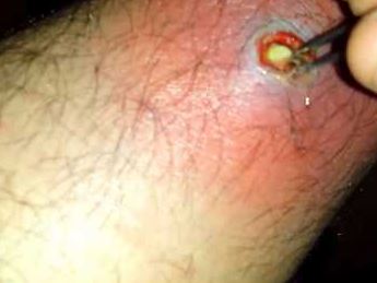 Infected Hair Follilce Picture