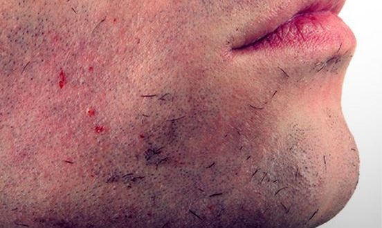 Ingrown Facial Hair Cyst, Bump, Deep Infection, Causes