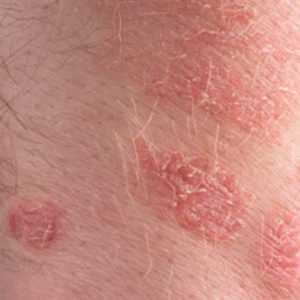 Itchy red spots on skin have a chance to become eczema and psoriasis pictures