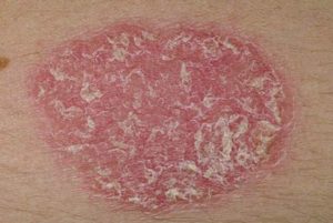 Red spots on skin, acquired psoriasis
