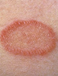 Red spots on skin, picture of pityriasis rosea