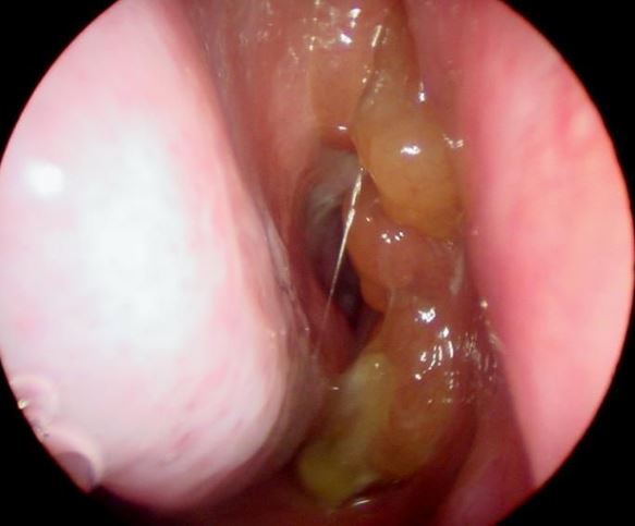 Smelly Mucus in Nose caused by Nasal Polyps