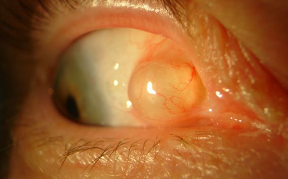 Cyst on Eyeball Picture