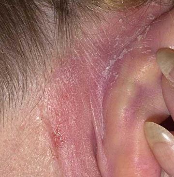 Dry Skin Behind Ear Cracked Skin Baby Causes Psoriasis Itchy 