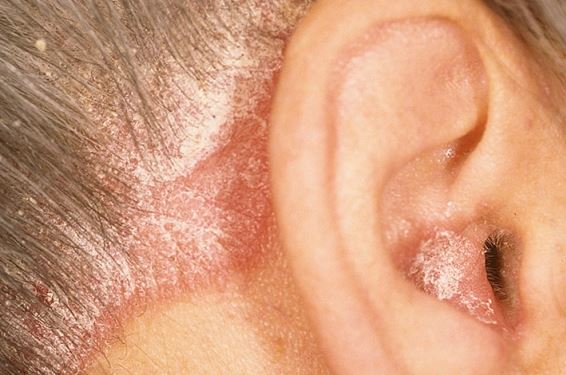 Dry Skin Behind Ear Cracked Skin Baby Causes Psoriasis Itchy 