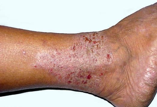 Dry Skin On Legs Pictures Extremely Dry Skin Between Legs Look Likes