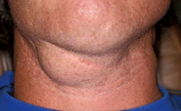 Lump under Chin near Throat