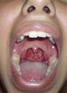Lump In Back of Throat, Feeling, Hard, Large Lump, behind Uvula, near