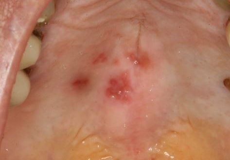 Lump on Roof of Mouth: Causes, Pictures, NHS, Hard Bumps, Small, Large