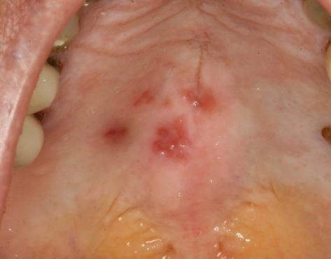 Small or Little Lumps on Roof of Mouth