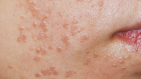 how to get rid of small warts on face naturally