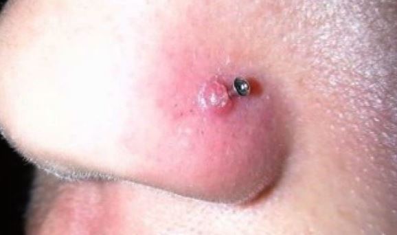 Nose Piercing Bump