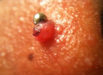Nose Piercing Keloid
