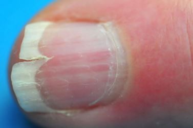 Nail Splitting could be Vitamin deficieny