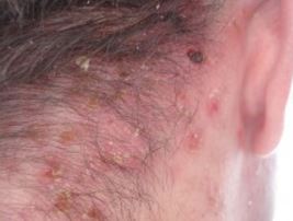 Image of Shingles on Scalp and Neck