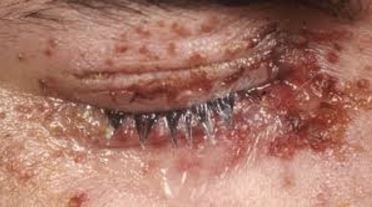 Shingle in the Eye Symptoms