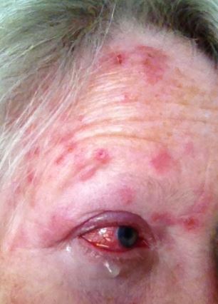 Shingles on Forehead and in the Eye Picture