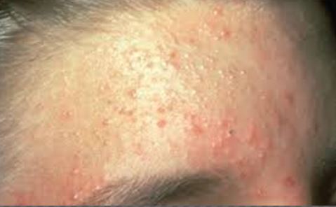 Yeast Infection Bumps, Pimples, Male, White Spots, Pictures, Cause