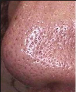 Large Pores on Nose