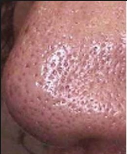 How To Get Rid Of Large Pores On Nose Cheeks Home Remedy And 
