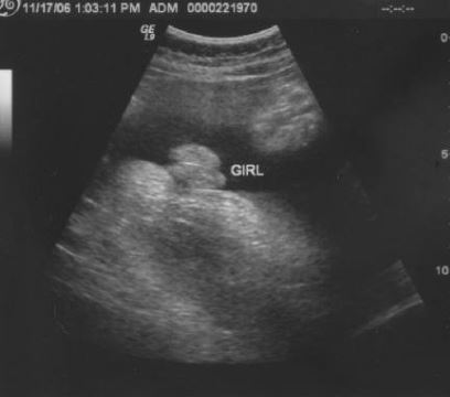 Swollen Labia Ultrasound Pictures