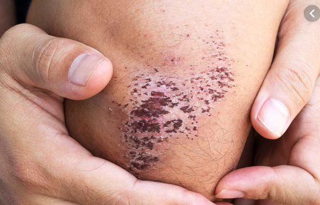 How to Get Rid of Scabs Fast and Naturally