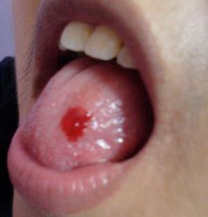 Bitten Tongue Bleeding