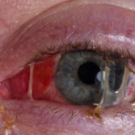 Irritate Eyes Causes