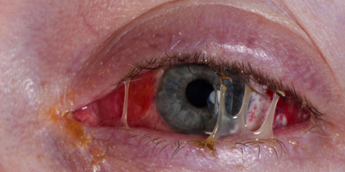 Irritated, Sore Eyes, Symptoms, Causes, In the Morning, Cure, Treatment, Home Remedies