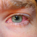Irritated Eyes