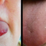 Bruised Tongue Picture