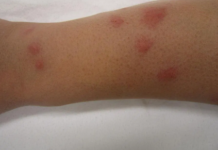 Pictures-of-bed-bugs-bites